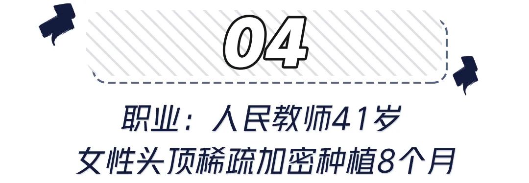 前额头发秃面相 世界里没有容易二字，除了发胖还可能是元凶！