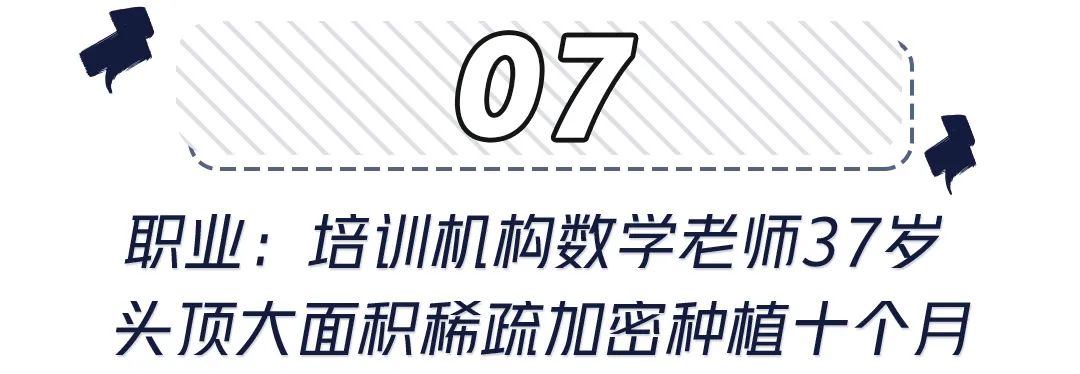 前额头发秃面相 世界里没有容易二字，除了发胖还可能是元凶！