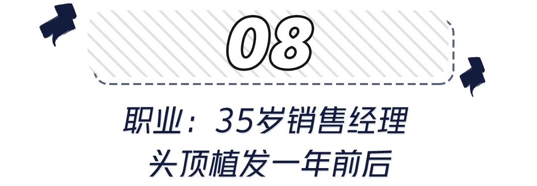 前额头发秃面相 世界里没有容易二字，除了发胖还可能是元凶！